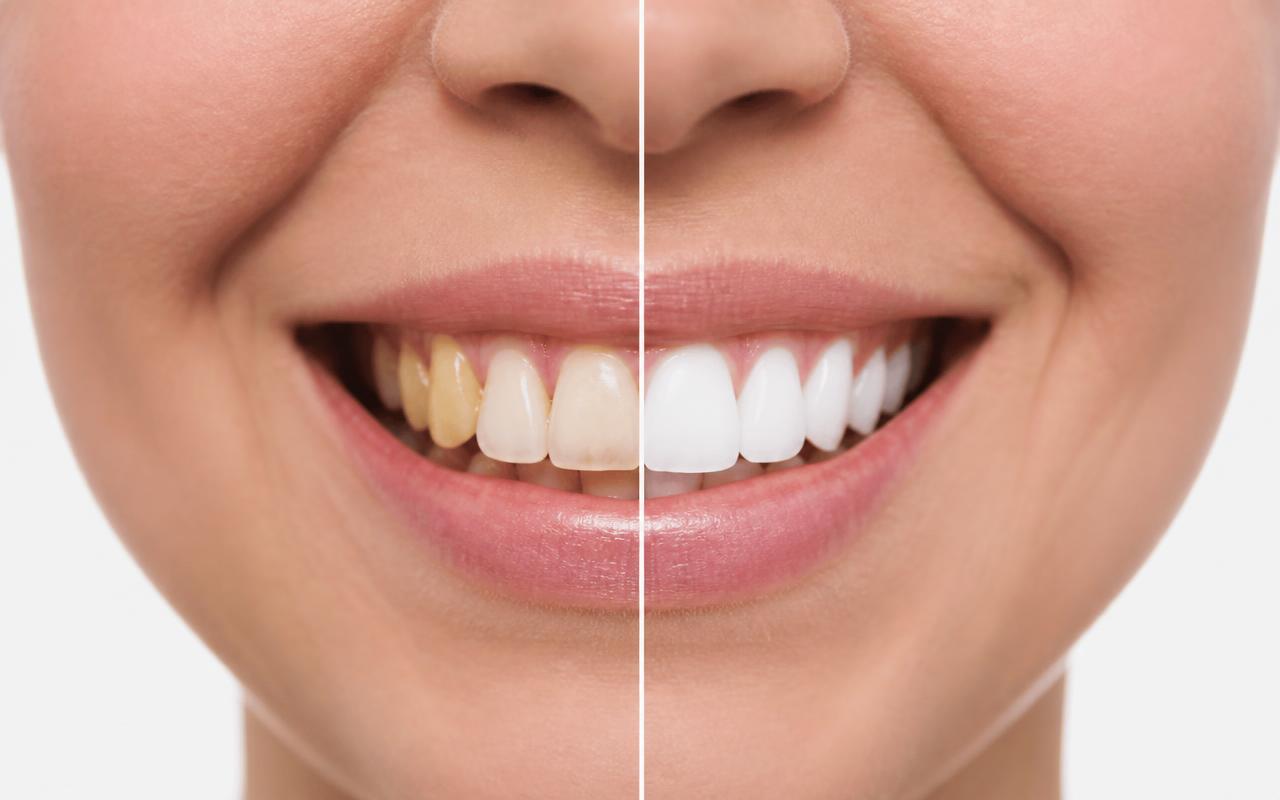 Teeth whitening pre-op and post-op result